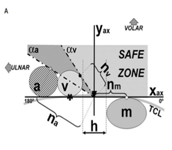 Mini-open carpal tunnel release: technique, feasibility and