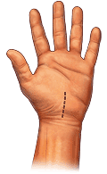 Open Carpal Tunnel Incision