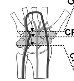 ultrasound-guided-carpal_med-2