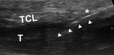 ultrasound-guided-carpal_med_hr-4